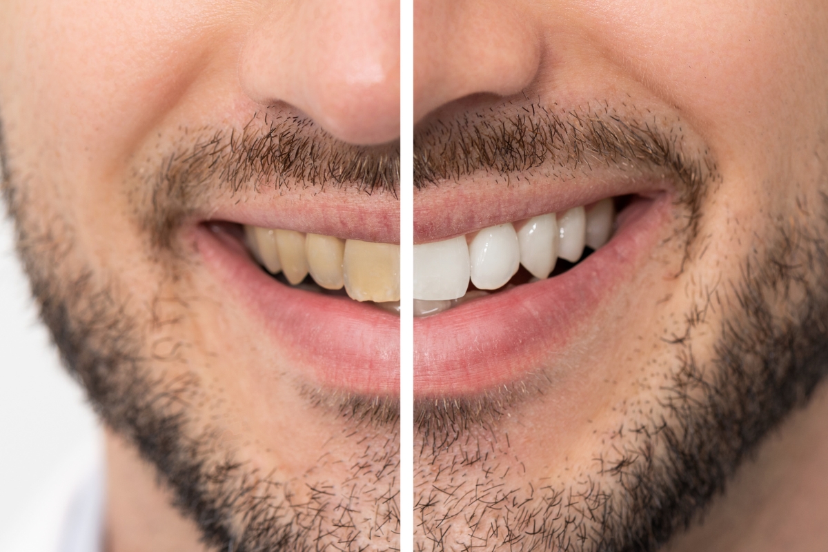 how can alcohol affect the results of your whitening treatment