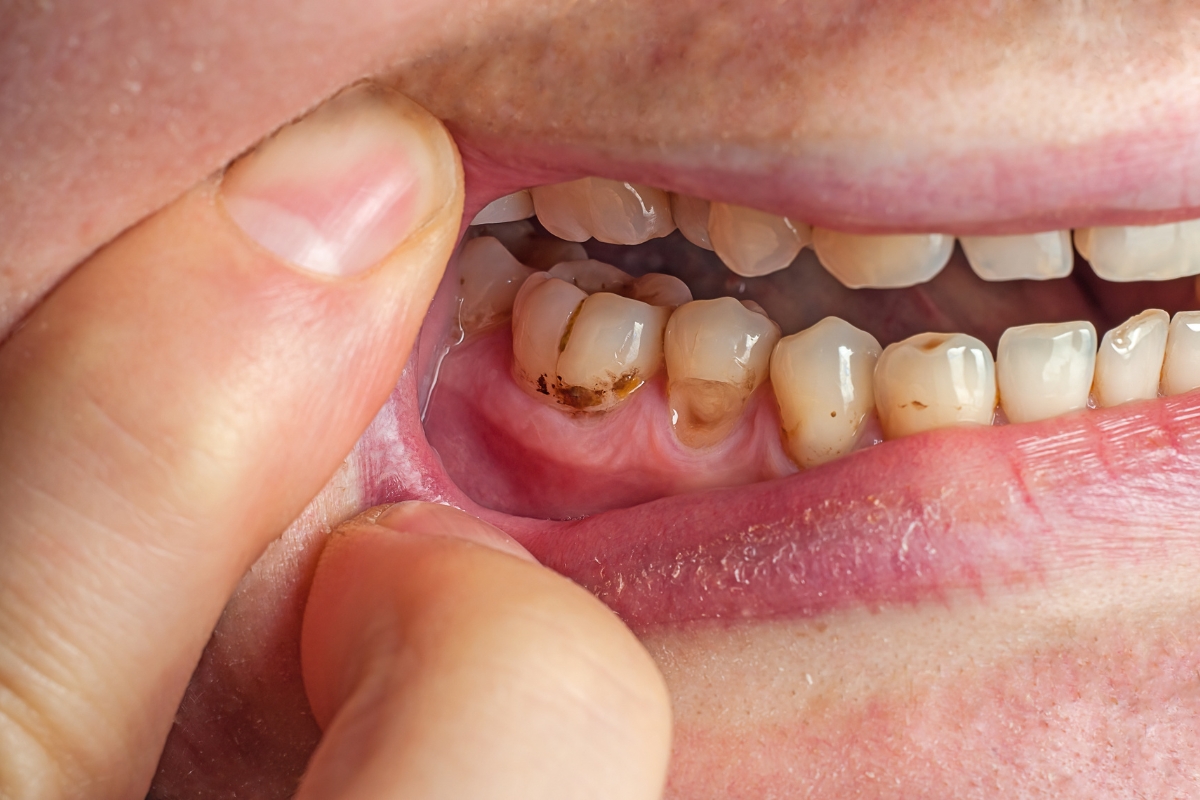 what are your options if you have really bad teeth